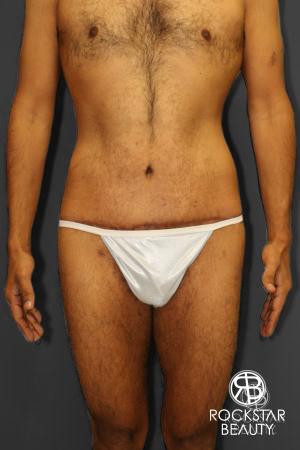 Body Lift: Patient 1 - After Image 1