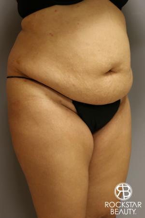 Tummy Tuck: Patient 2 - Before Image 2