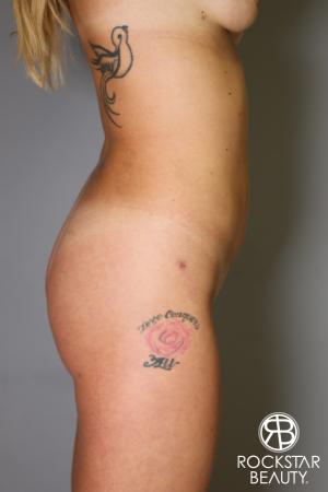 Brazilian Butt Lift: Patient 6 - After Image 4