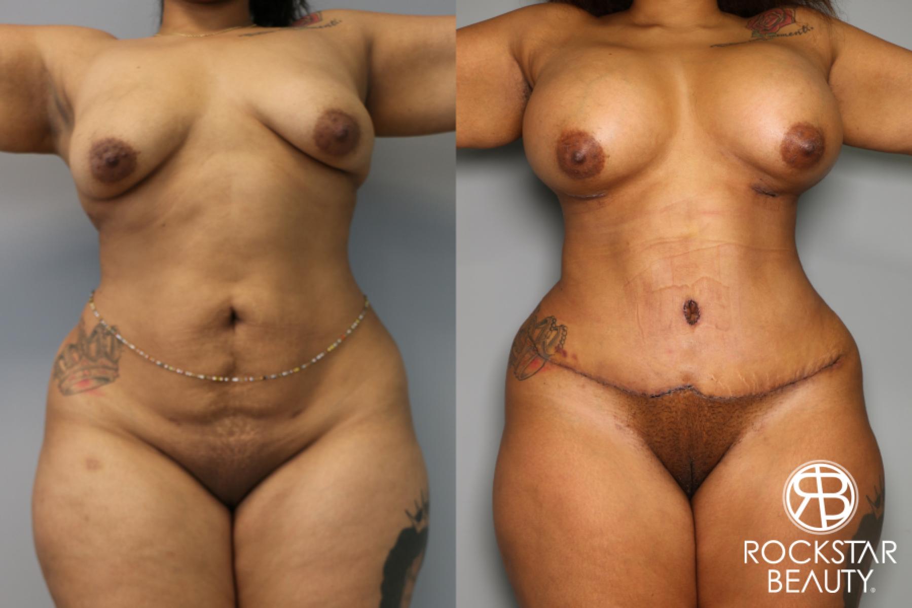 Tummy Tuck: Patient 4 - Before and After 1