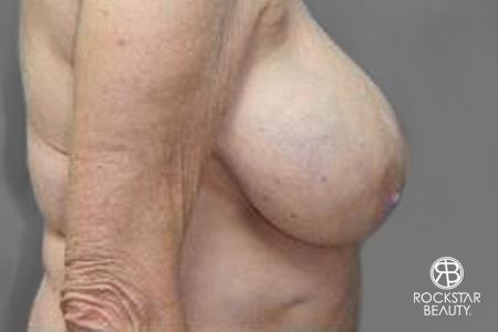 Breast Reduction: Patient 2 - Before and After 3
