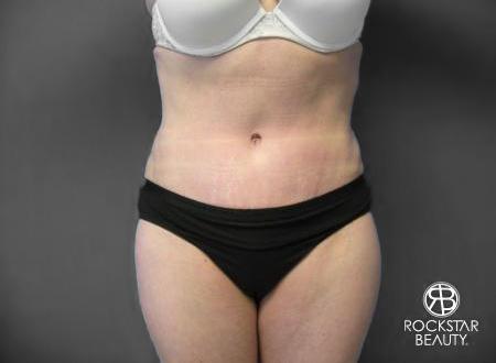 Tummy Tuck: Patient 6 - After 1