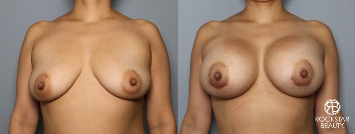 Breast Augmentation: Patient 60 - Before and After 1