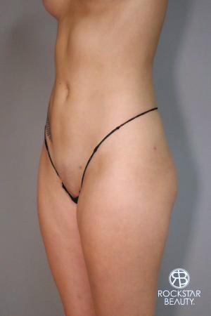 Liposuction: Patient 9 - After 2