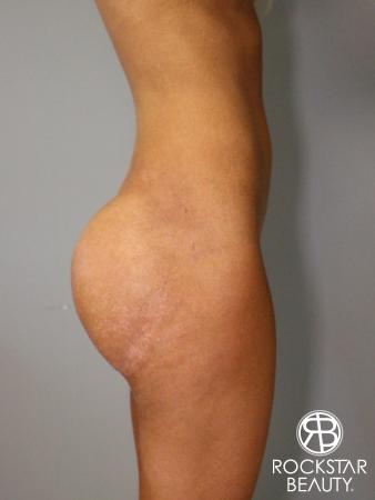 Butt Augmentation: Patient 1 - After Image 3