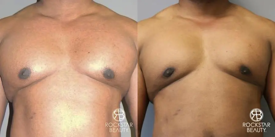 Gynecomastia: Patient 1 - Before and After 1