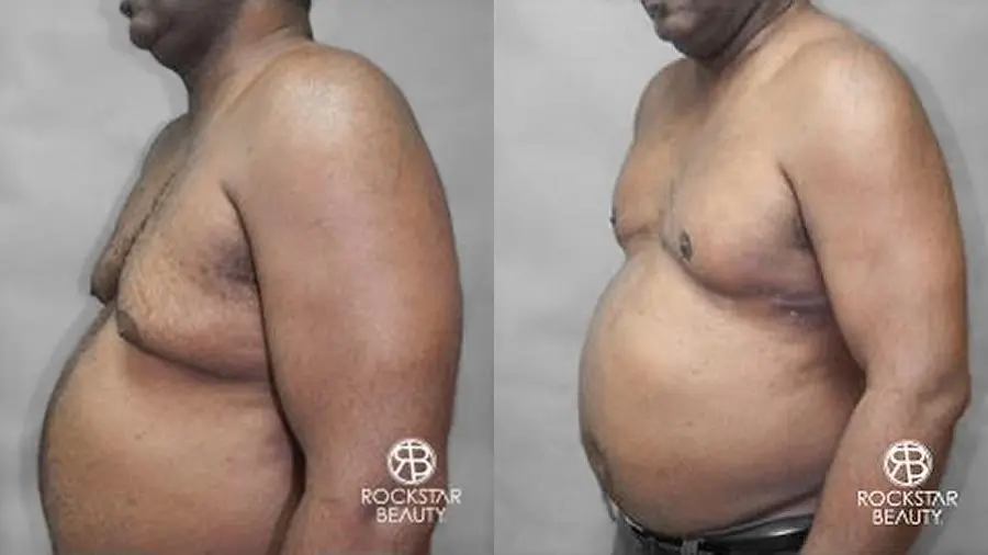 Gynecomastia: Patient 2 - Before and After 2