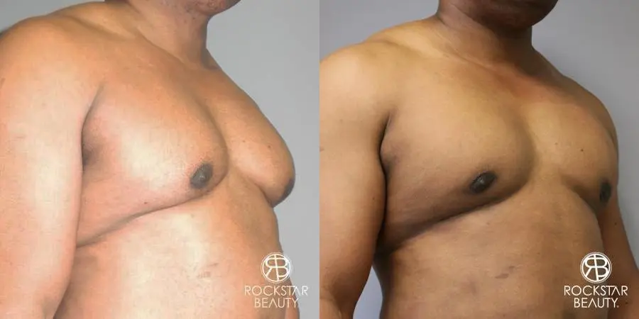 Gynecomastia: Patient 1 - Before and After 2