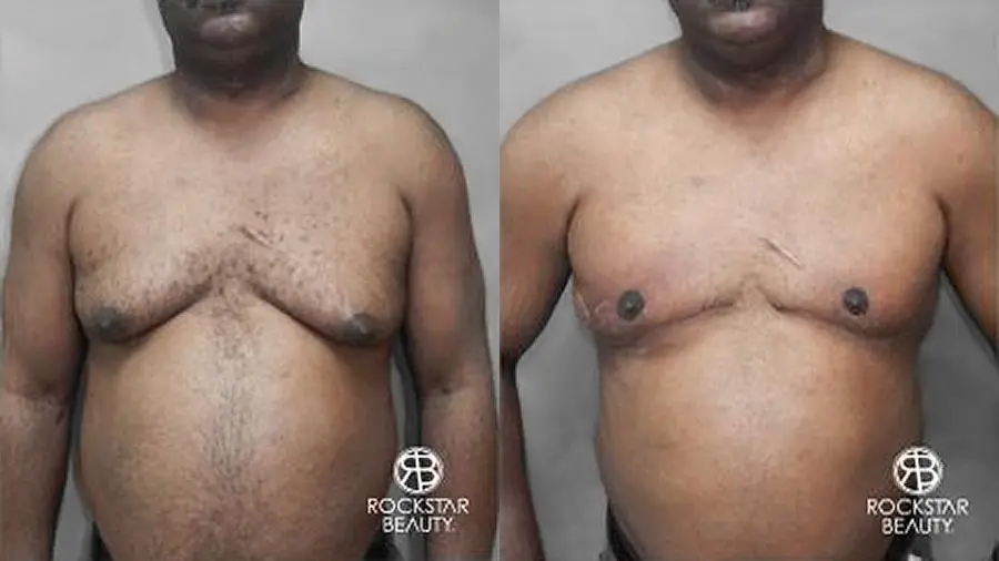 Gynecomastia: Patient 2 - Before and After 1