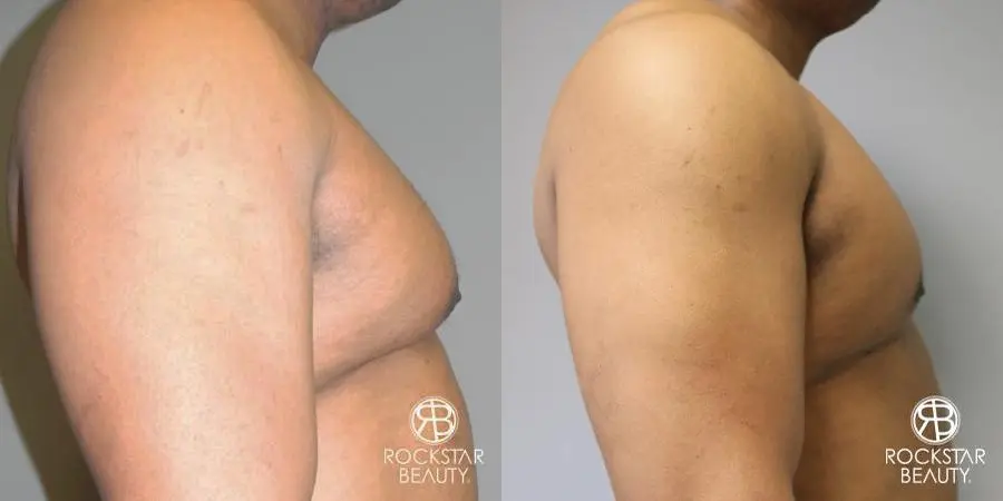 Gynecomastia: Patient 1 - Before and After 3