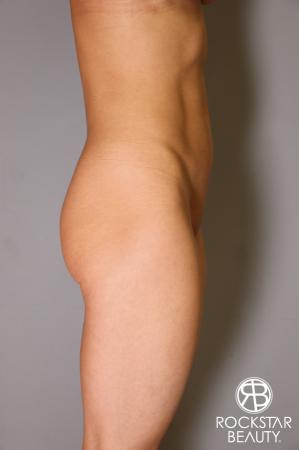 Butt Augmentation: Patient 3 - Before Image 2