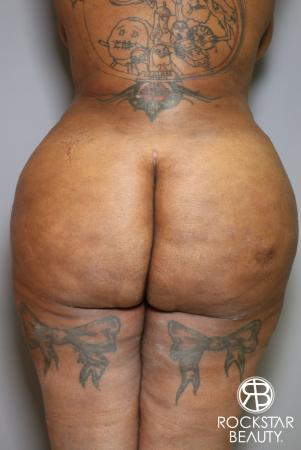 Brazilian Butt Lift: Patient 15 - After Image 1
