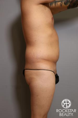 Tummy Tuck: Patient 5 - Before and After Image 4