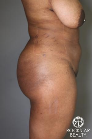 Brazilian Butt Lift: Patient 13 - After Image 2