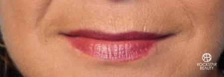 Lip Augmentation: Patient 1 - Before Image 1