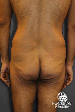 Body Lift: Patient 1 - Before and After Image 4