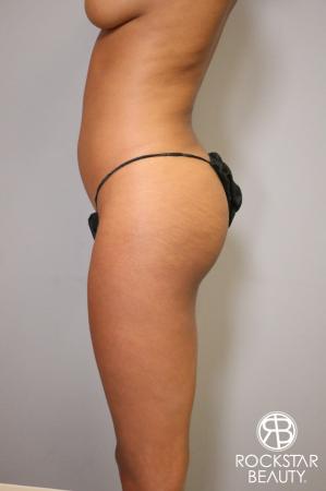 Liposuction: Patient 1 - Before Image 4