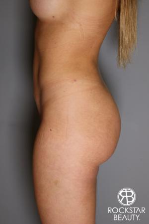 Brazilian Butt Lift: Patient 16 - After Image 2