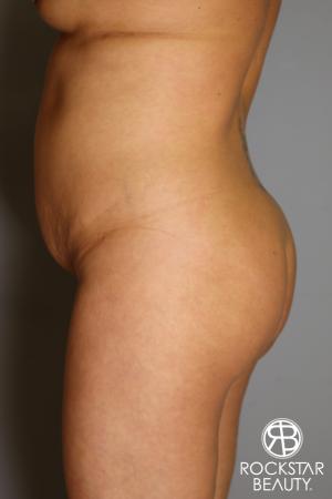 Brazilian Butt Lift: Patient 12 - Before and After Image 4