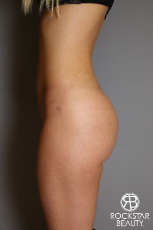 Brazilian Butt Lift: Patient 2 - After Image 2