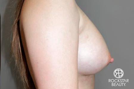 Breast Augmentation: Patient 6 - After 3