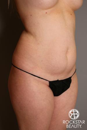 Liposuction: Patient 11 - Before Image 2