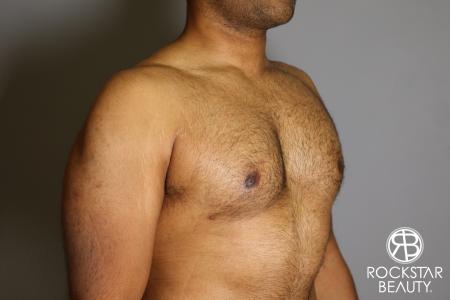 Liposuction: Patient 16 - After Image 4