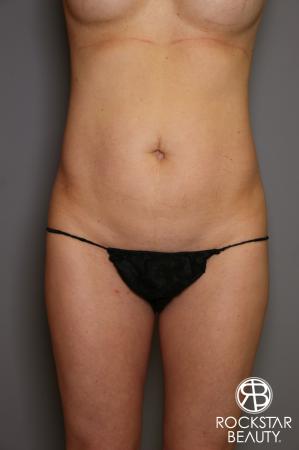 Liposuction: Patient 13 - Before Image 1