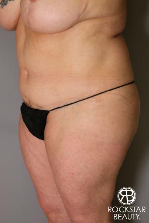Tummy Tuck: Patient 12 - After Image 2