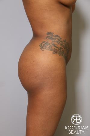Liposuction: Patient 18 - After Image 5