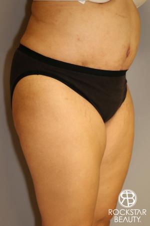 Tummy Tuck: Patient 2 - After Image 2