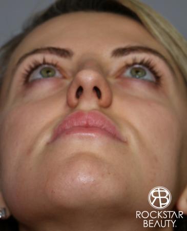 Rhinoplasty: Patient 1 - Before and After Image 5