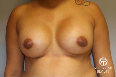 Breast Augmentation: Patient 9 - After  