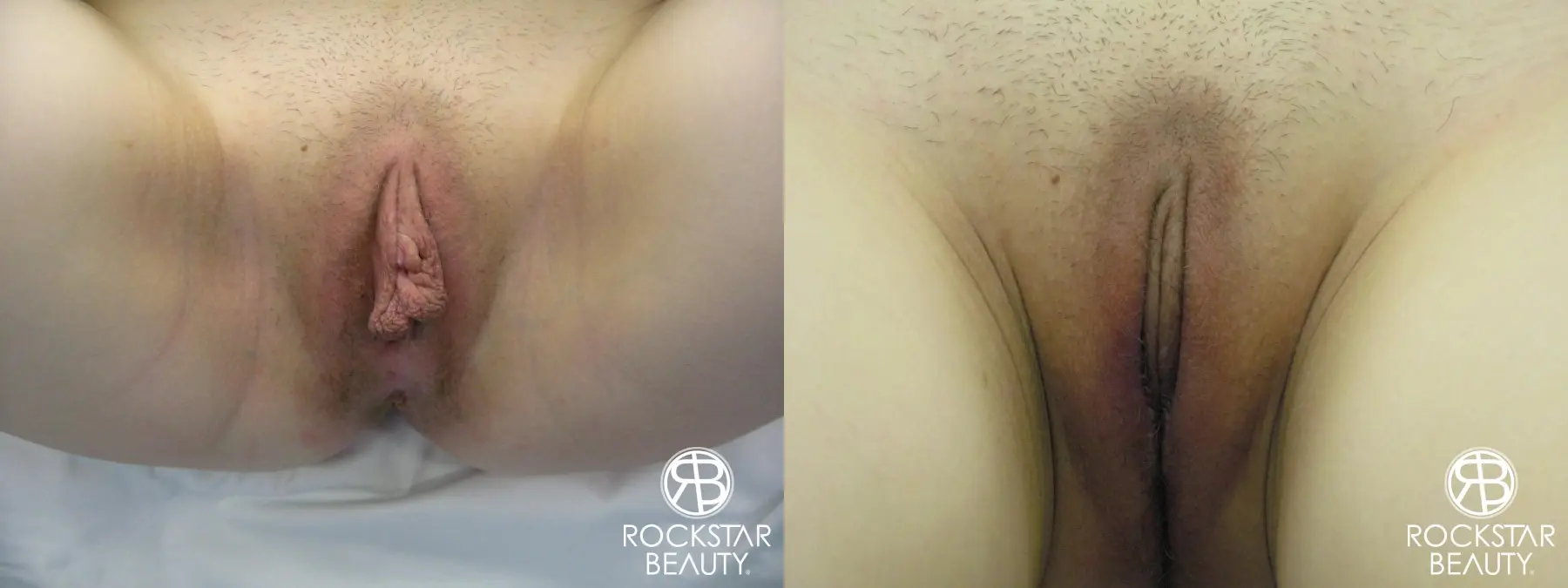 Labiaplasty: Patient 1 - Before and After 1