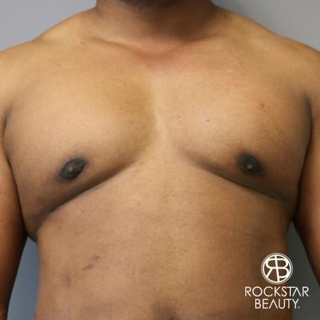 Gynecomastia: Patient 1 - After 1