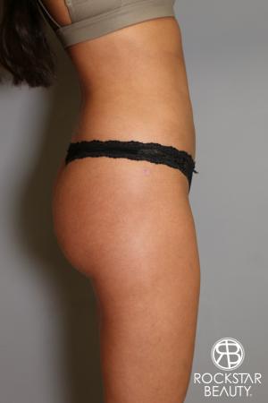 Brazilian Butt Lift: Patient 5 - After Image 3