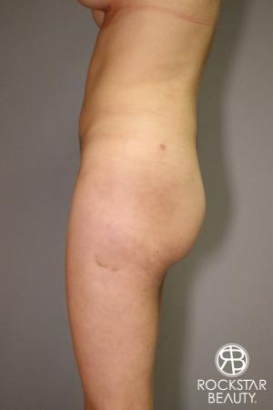 Liposuction: Patient 2 - After Image 3
