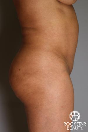 Brazilian Butt Lift: Patient 11 - Before Image 4