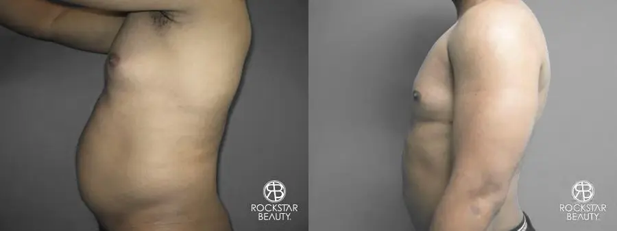 Liposuction: Patient 10 - Before and After 5