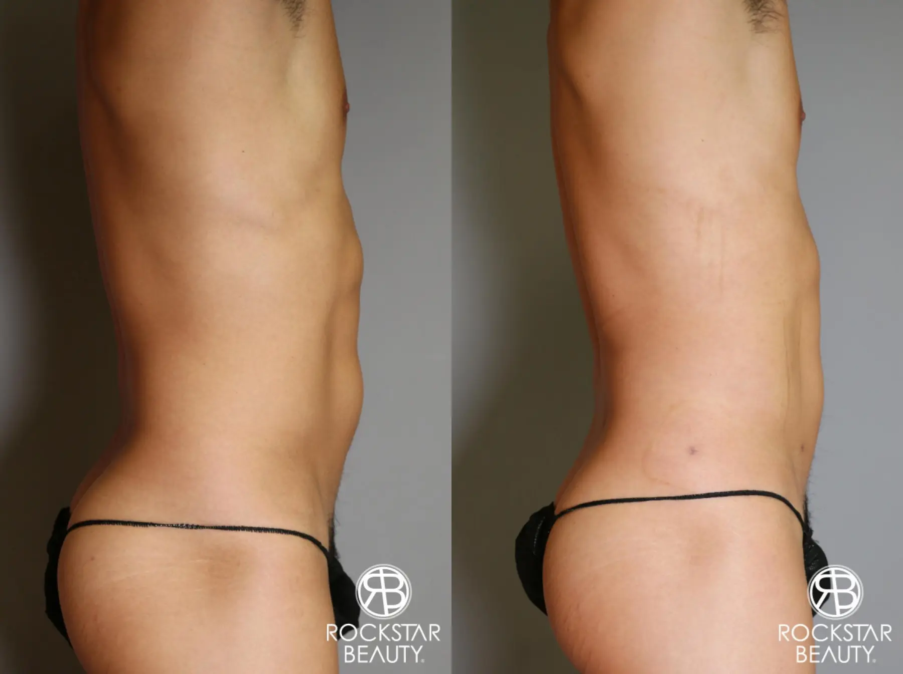 Liposuction: Patient 17 - Before and After 1