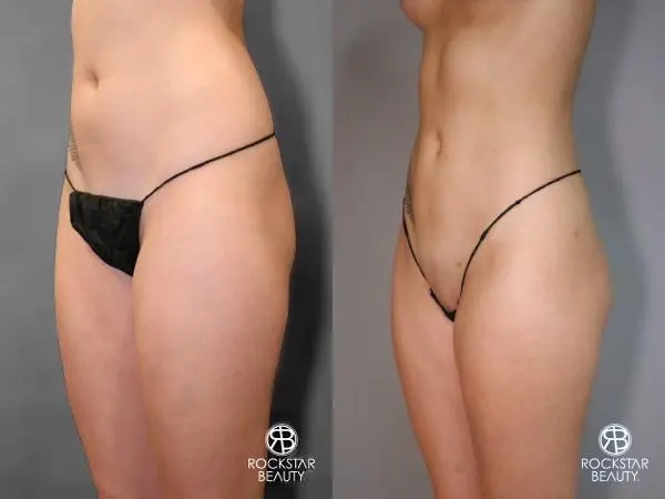 Liposuction: Patient 9 - Before and After 2