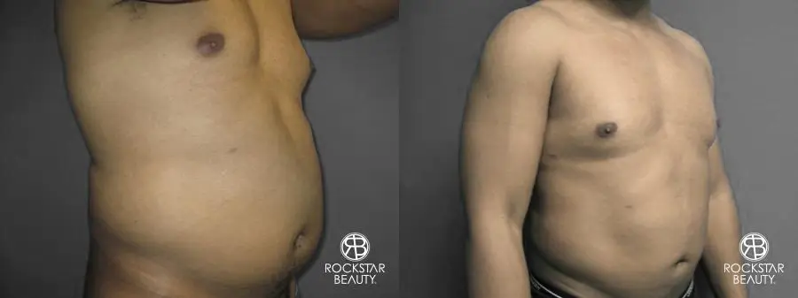 Liposuction: Patient 10 - Before and After 2