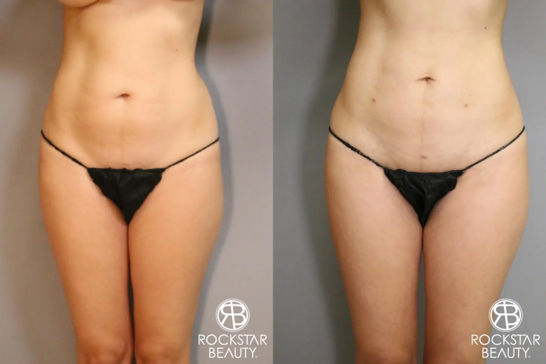 Liposuction: Patient 5 - Before and After  