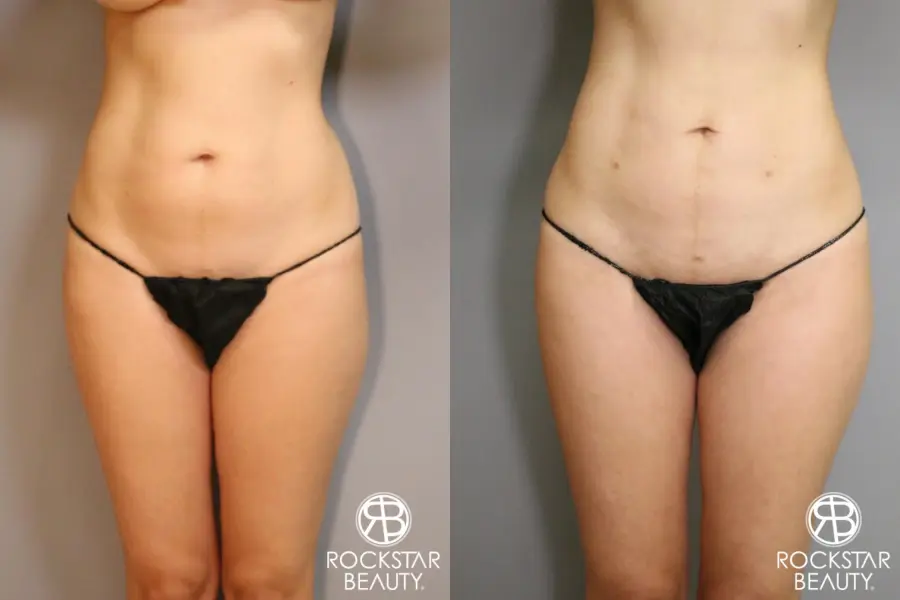 Liposuction: Patient 5 - Before and After 1