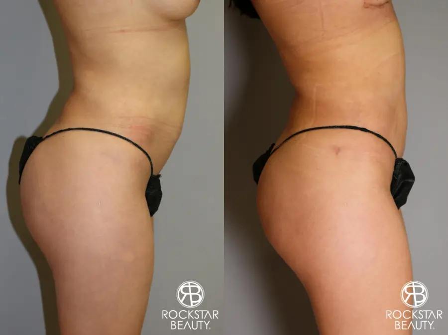 Liposuction: Patient 14 - Before and After 5