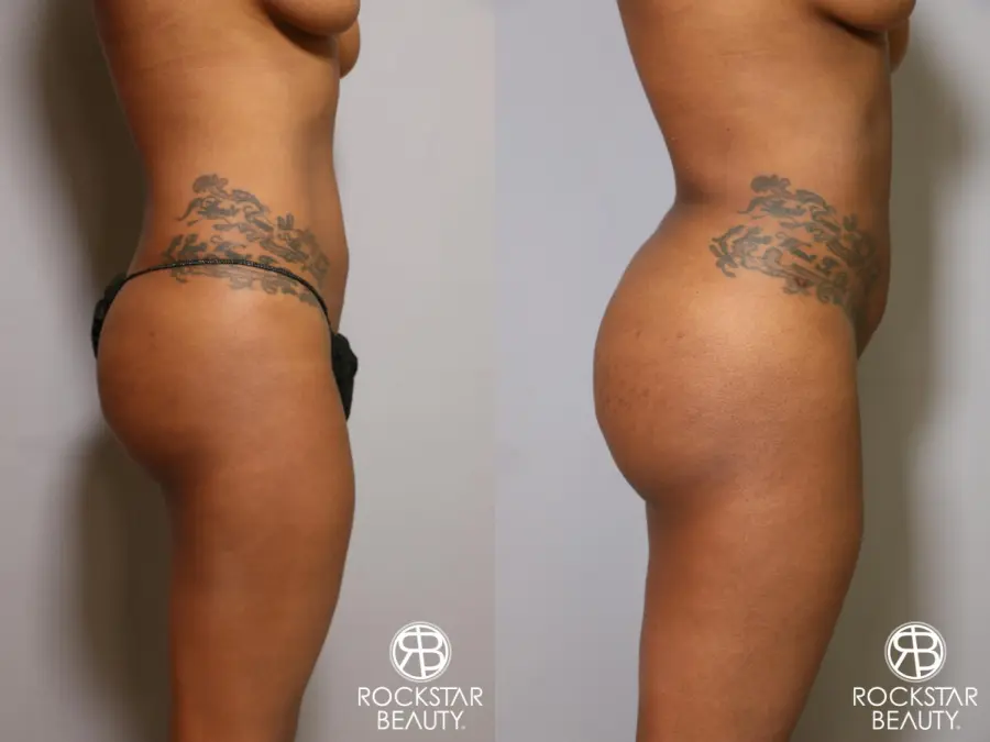 Liposuction: Patient 18 - Before and After 5