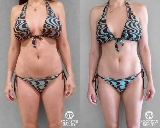 Liposuction: Patient 8 - Before and After 1