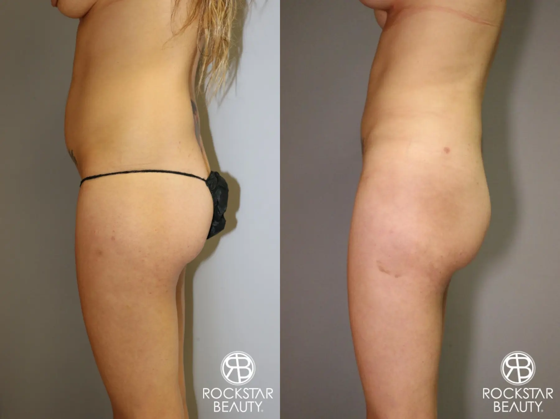 Liposuction: Patient 2 - Before and After 3