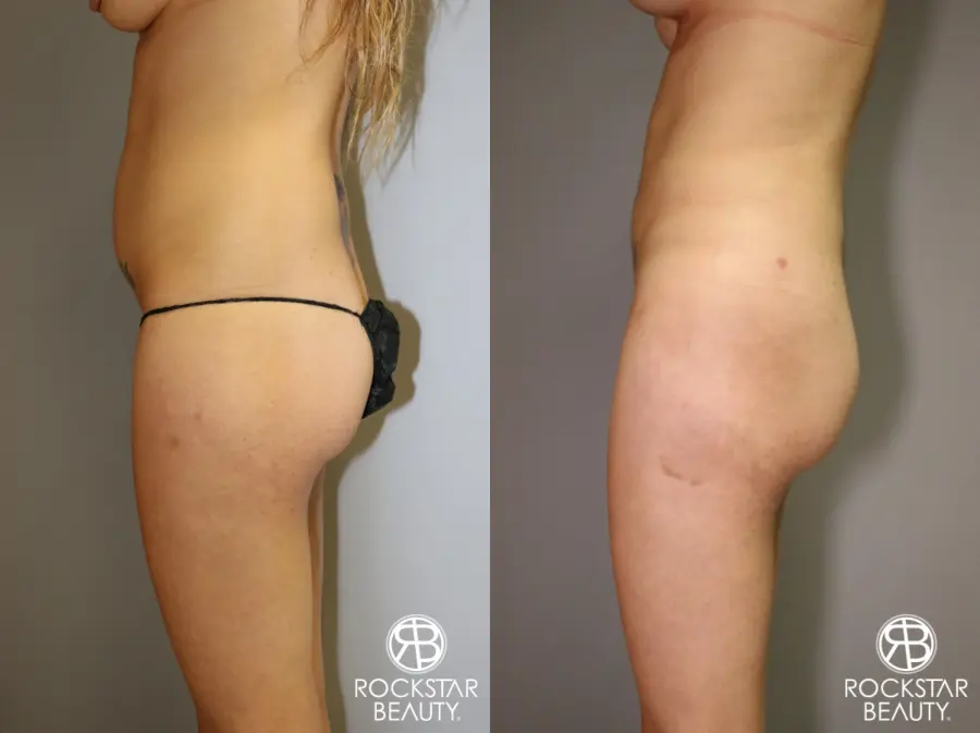 Liposuction: Patient 2 - Before and After 3
