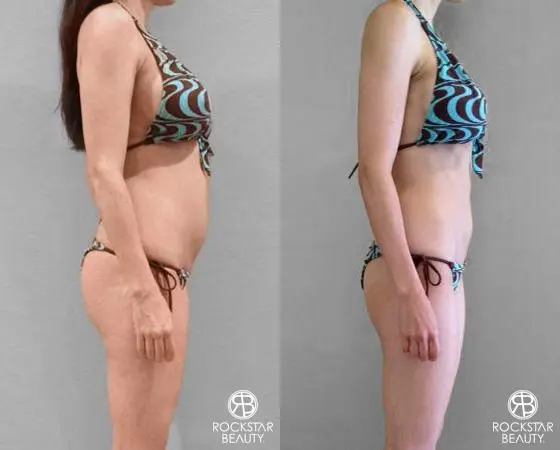 Liposuction: Patient 8 - Before and After 2